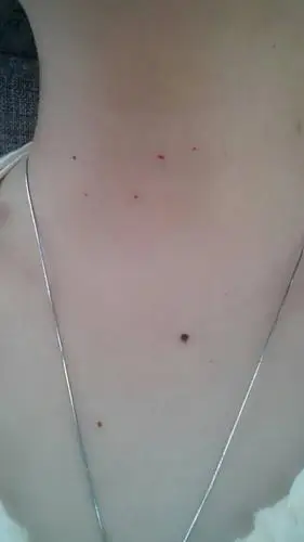 身上出现了少量的小红血点,不痛不痒,将近1个月的时间了,有照片,在线