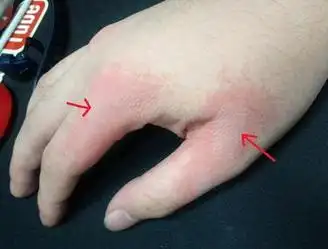 乃传一祖传方,云:其儿子3岁时,误将1壶开水弄翻,导致从肩至肘深度烫伤