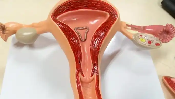 避孕环是什么(抑制环是啥)