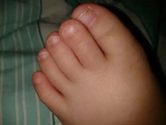 宝宝的脚趾怎么回事.总是压着大拇指