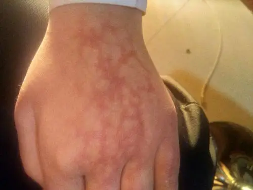 手总很多时候总是出现纹路,我的手很多时候会有纹路,手背,这次是红色