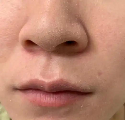 "节"后余生,国庆过后的护肤常识,针对皮肤干燥起皮,过敏泛红__凤凰网