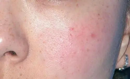 修复敏感肌去除红血丝怎么管理效果最好