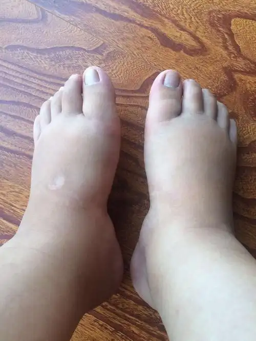 孕晚期腿脚水肿怎么办呀