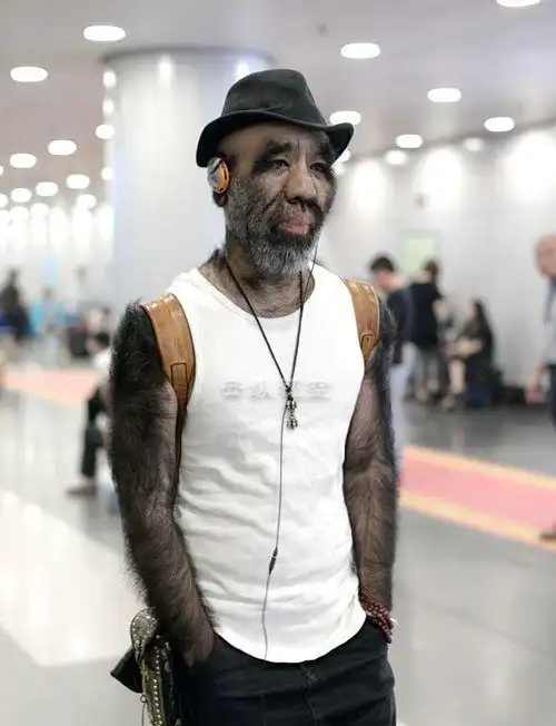 出生便患有多毛症体毛太多遭人排斥如今的模样却美翻全场