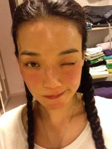 秦岚自曝因拍戏差点毁容,满脸爆痘四处求医:当时觉得完了