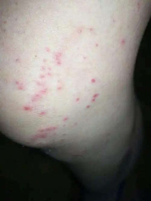 我的皮肤上很多这样的红点不痛不痒,手机和脚上,不痛不痒