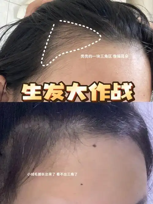 发际线高m型发际线别灰心60亲测生发广