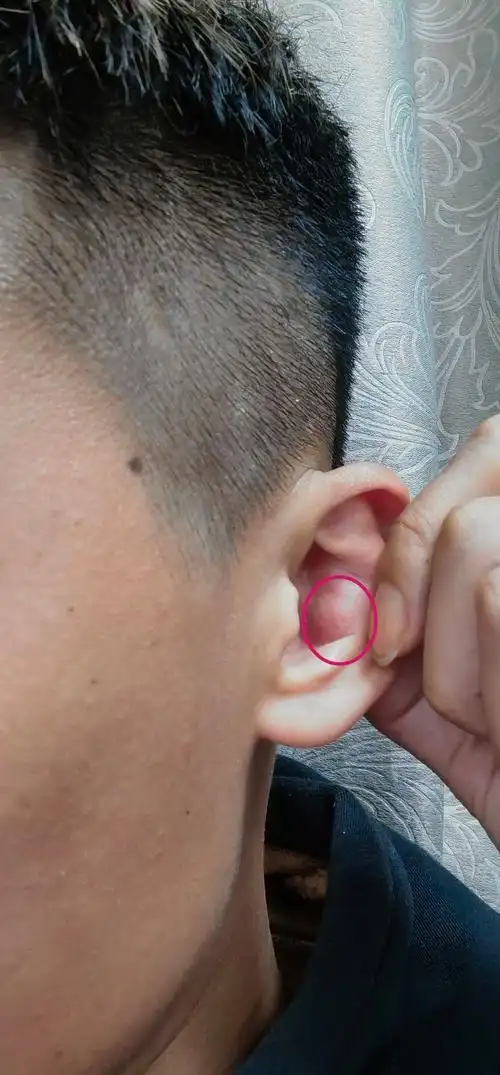 耳朵长了个胞 - 知乎