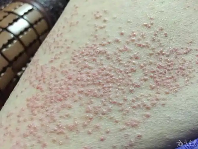 大腿毛囊性红色丘疹轻痒数周用了去尿炉甘石效果不好皮疹更明显两侧
