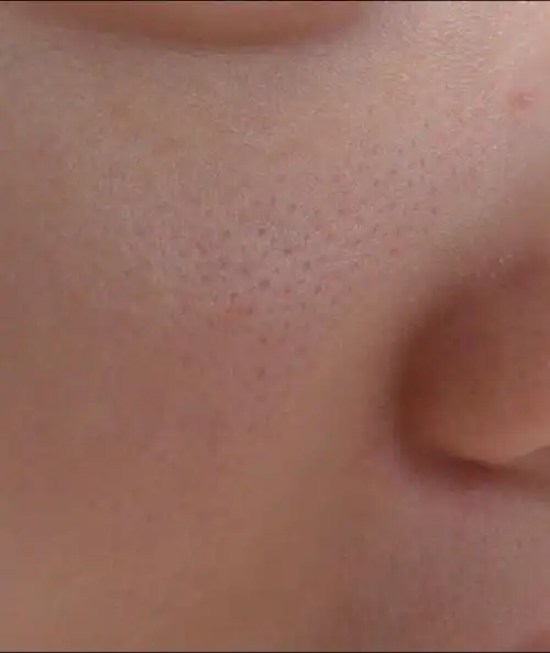 (密集恐惧症者慎入)帮忙一下,帮我看看这是什么类型的毛孔?