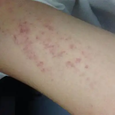 花粉过敏啊或者其他导致的过敏,还有一种可能是毛囊堵塞造成的毛囊炎