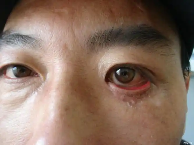 外伤后下眼睑外翻,如何手术,大家给个建议?