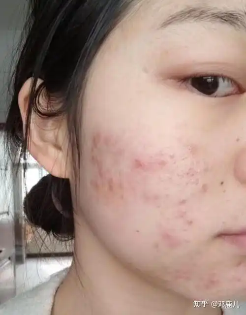 刚上大学那会我长了满脸痘痘,自卑死了!