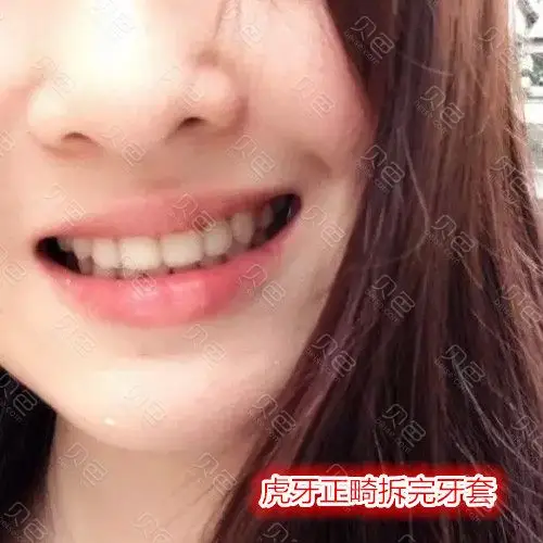 32岁虎牙正畸过程分享,花了17个月的时间终于变得美美哒!
