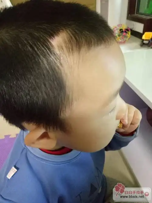 2岁多小孩白发有可能恢复吗?有什么药物可以治疗吗?