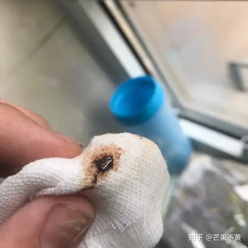 经历过割包皮手术是种怎样的体验