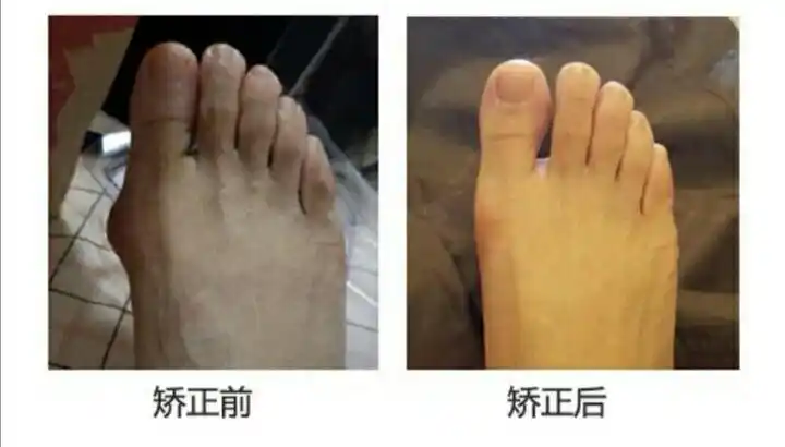 拇外翻"为虎林人民带来"美足" 写美篇千里之行始于足下,请善待你的脚