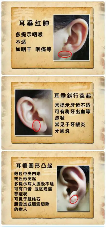 【20120914播出】耳垂红肿:多提示咽喉不适,如咽干,咽痛等.
