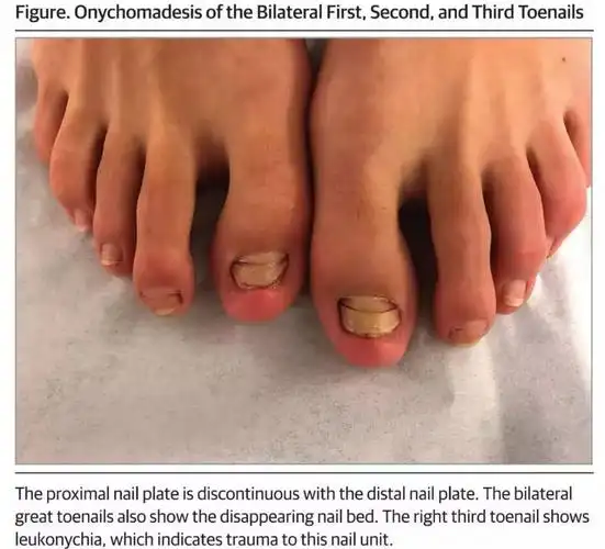 澳洲女子在泰国做鱼疗后脚趾感染6年里右脚的脚趾全被截肢有图有真相