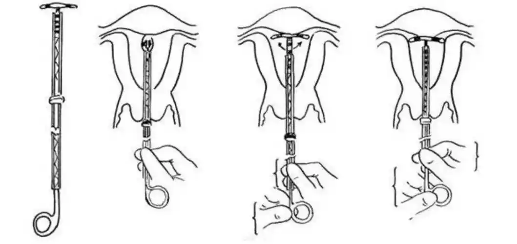 金灿灿!节育环的价格"优雅诞生"-第1张图片-天福博客