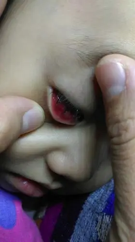 宝宝下眼皮里有个泡泡,怎么办