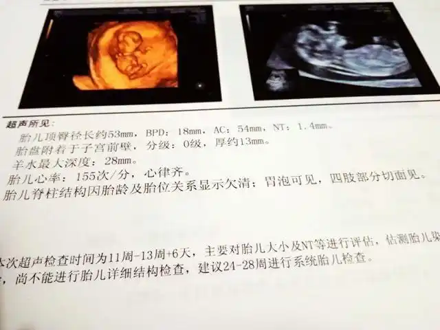 怀孕12周要做nt检查很多孕妇却不知道nt到底是什么