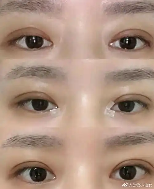 我尝试的是一款7mm的小平行双眼皮,效果既不会过于夸张,也不会显得