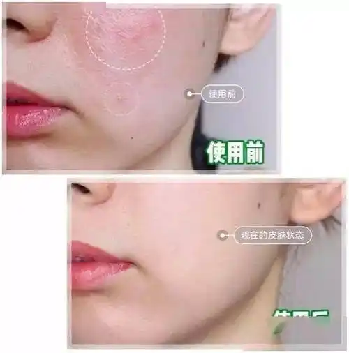 被湿疹折磨的苦不堪言?那是因为你没有用对方法!_消炎