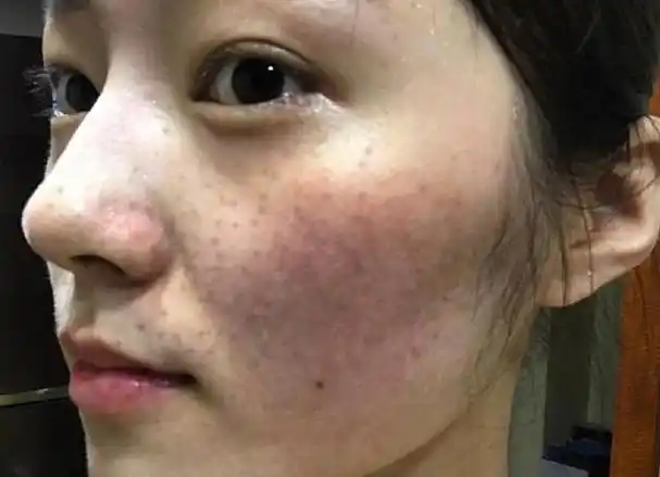 脸上长满斑点,可能是因为3件事,2个小方法,或能淡斑美白