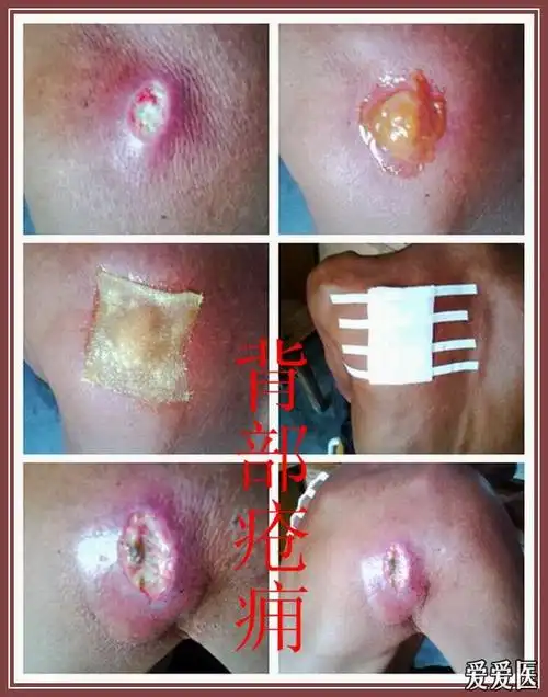 左背后生疮的病人