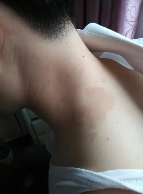 颈背皮肤红斑