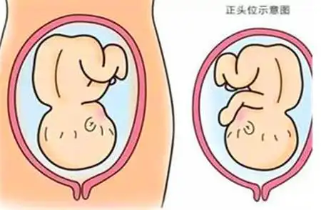 怎样加快胎儿入盆?