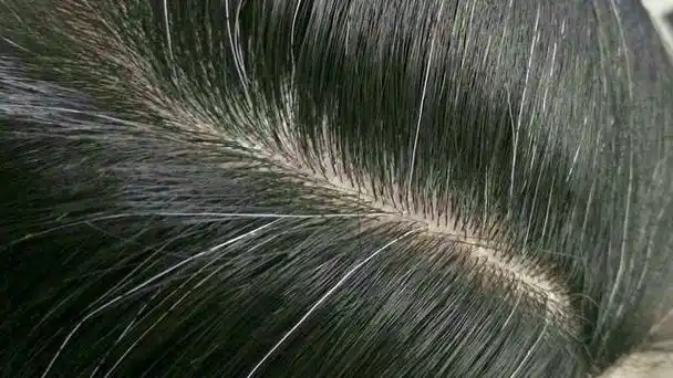 33岁头顶白发我焦虑了