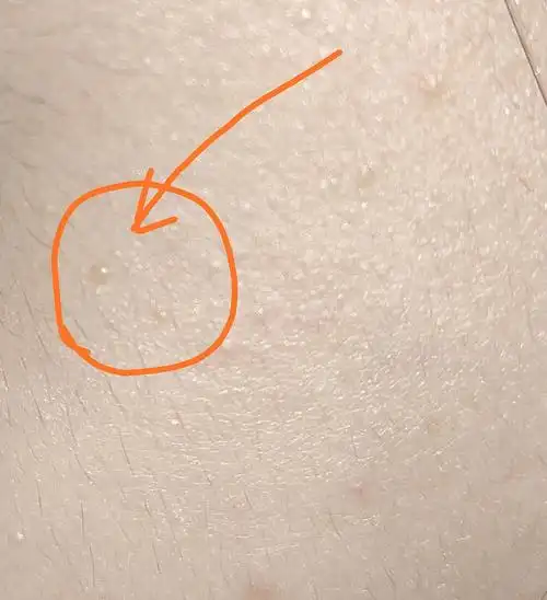 这是啥脸上长的肤色不痛不痒的小凸起2年多了没变大比芝麻还小一点