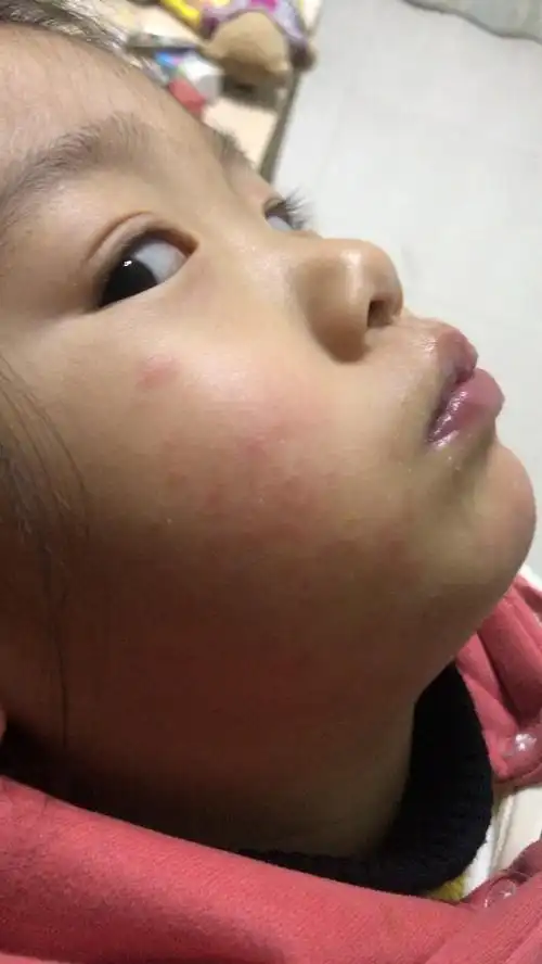 宝宝脸上突然红了一片.宝宝不挠应该不痒.摸点什么药好什么症状