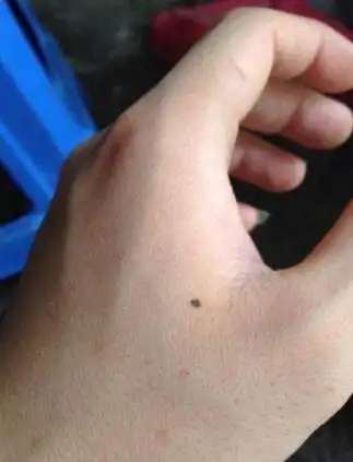 所以性格有些阴晴不定,如果是近期左手虎口长了痣,说明是最近一段时间