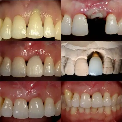 下门牙种植牙效果