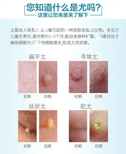 北京本草园研制疣瘊平 无腐蚀 qu除皮肤赘疣 内赠棉签5支