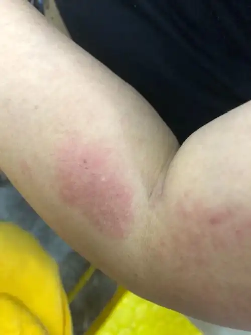 皮肤反反复复红肿,痒