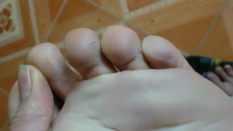 脚气很重很臭怎么办?穿拖鞋也会.男生22岁.