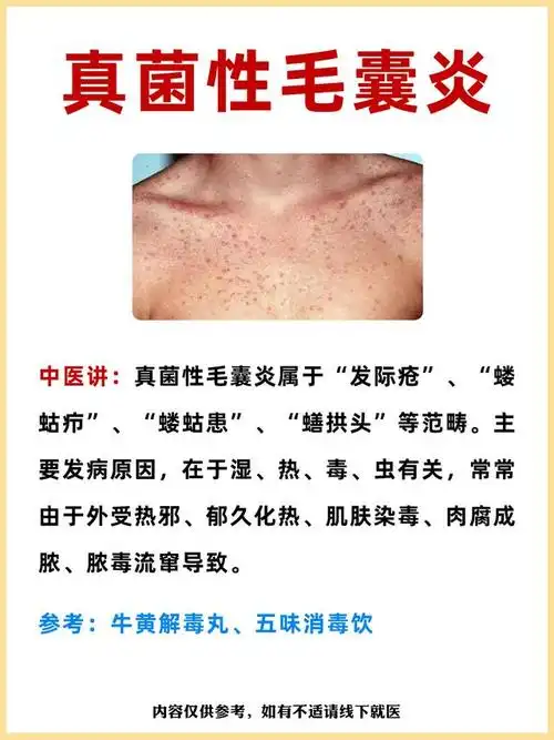 毛囊炎,4个中成药,细菌性,真菌性,病毒性,寄生性,统统消失