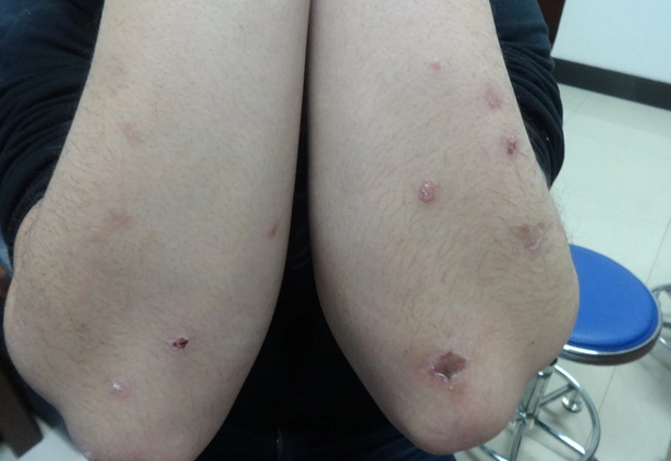 皮癣早期症状图片 (15)_有来医生