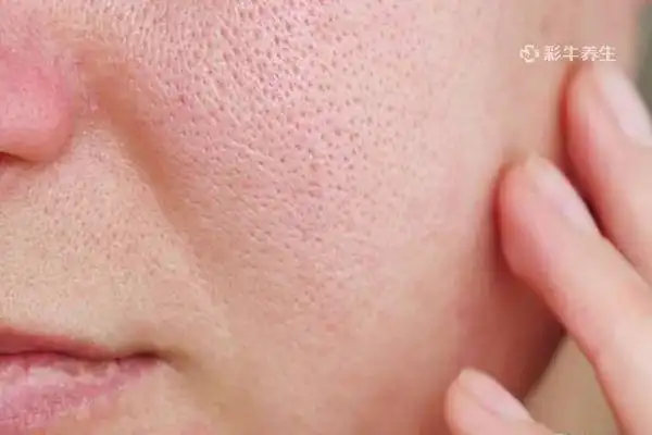 脸部毛孔粗大如何改善 改善脸部毛孔粗大的方法