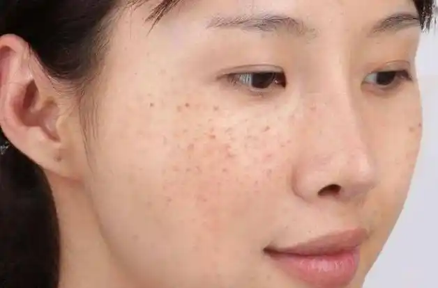 医生:不想满脸斑,4种蔬菜或少吃|色斑|黄褐斑|雀斑|皱纹|西红柿_网易