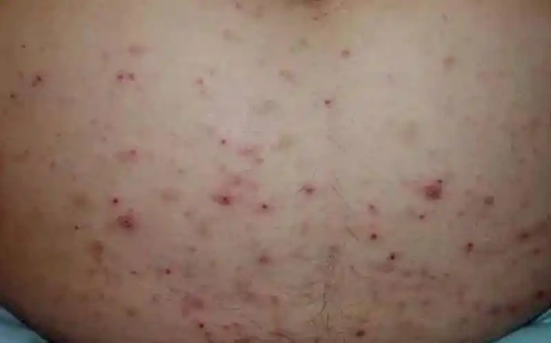 孕妇疥疮初期腹部皮肤症状图片