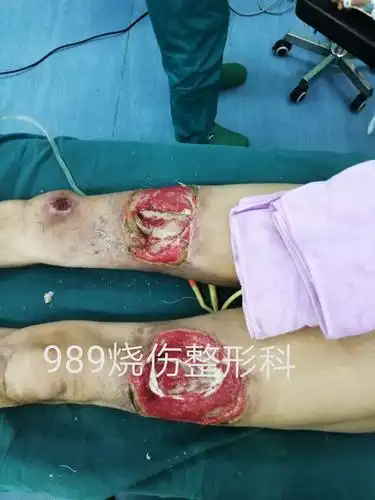 多种皮瓣修复重度电击伤创面一例 - 美篇
