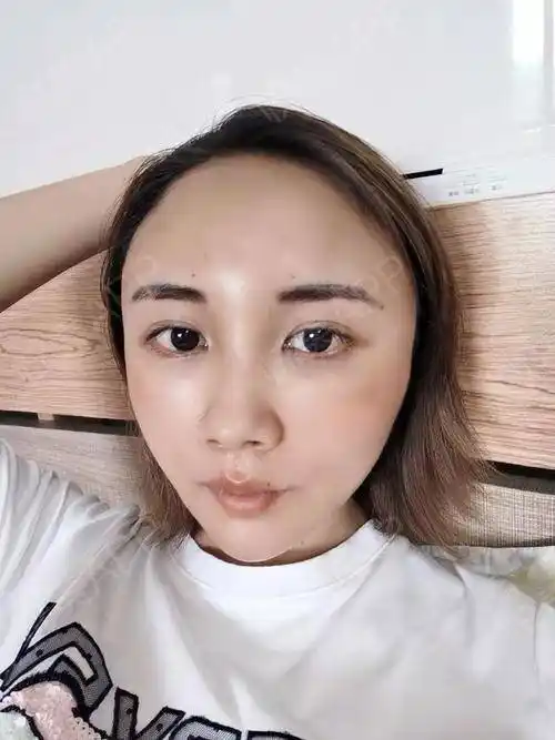 自体脂肪面部填充术后3天_面部填充术后3天_自体脂肪术后3天_花斑猫的