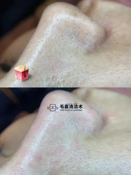 市面上唯一一款零过敏率_清洁_红血丝_深层清洁_护肤_祛痘_收缩毛孔