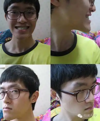 你是地包天都以为明星好当原来偷偷做了截骨术